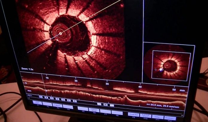 Optical Coherence Tomography (OCT) uses light rather than ultrasound to produce real-time high-resolution images of coronary arteries and deployed stents (photo: University Hospitals, Cleveland)