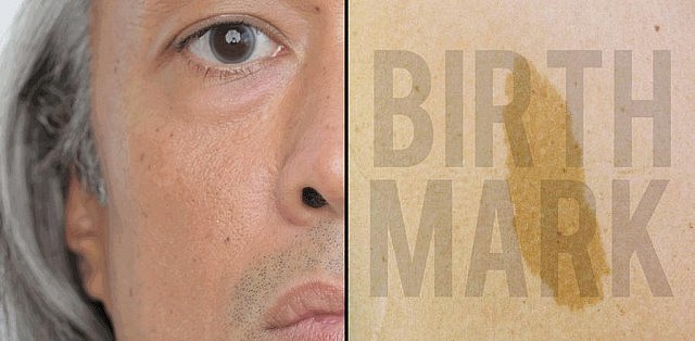 Lester Alfonso is the process of final edits to his documentary film "Birthmark", in which he tells the stories of people's birthmarks and how they have affected them