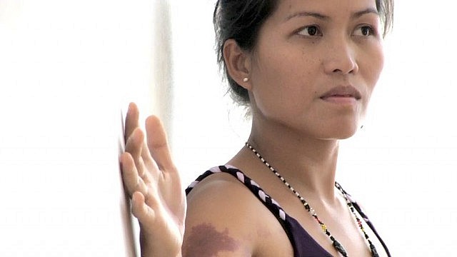 Musician and nurse Han Han, who grew up in the southern part of the Philippines, has a birthmark on her arm that has always been considered "suerte" (good luck) by those around her