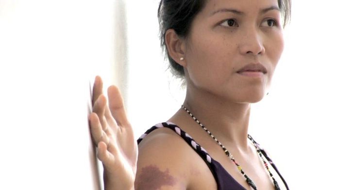 Musician and nurse Han Han, who grew up in the southern part of the Philippines, has a birthmark on her arm that has always been considered “suerte” (good luck) by those around her. (Photo courtesy of Lester Alfonso)