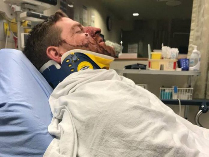 According to a public post on Facebook, Cody Wellman of Peterborough was assaulted early on Sunday morning outside The Social pub in downtown Peterborough, suffering a broken jaw and nose among other injuries. (Photo: Aimee Wellman / Facebook)