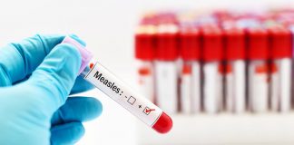 Measles test