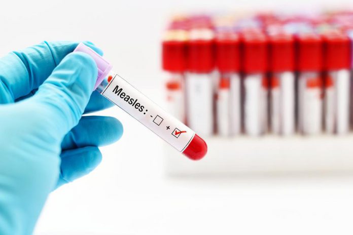 Measles test